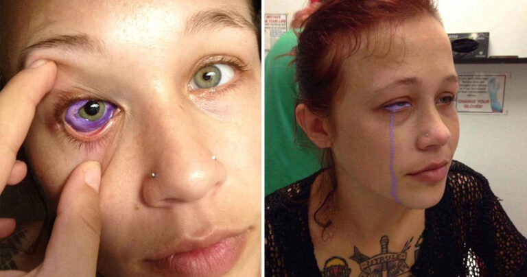 24χρονο μοντέλο κινδυνεύει να χάσει την όρασή του μετά από τατουάζ στο μάτι