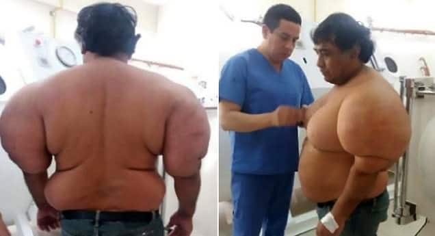 Δύτης παραμορφώθηκε όταν βγήκε απότομα στην επιφάνεια της θάλασσας