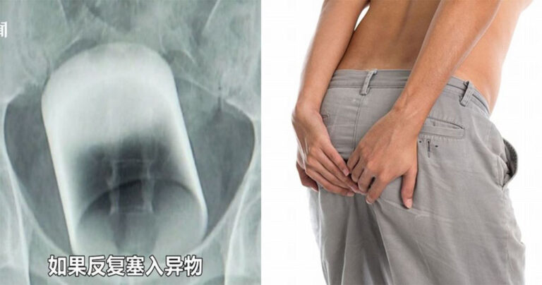 Γιατροί βρήκαν ποτήρι 8 εκατοστών στον πρωκτό άντρα στην Κίνα