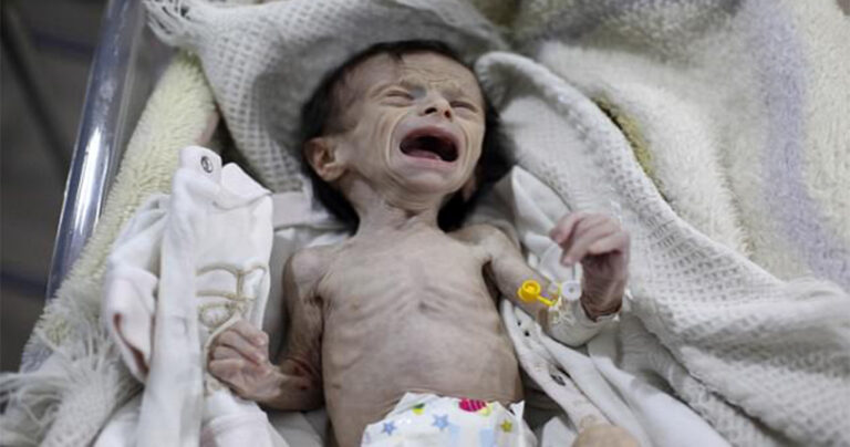 Θλιβερές εικόνες δείχνουν νοσηλευόμενο παιδί που πεθαίνει από την πείνα στην Συρία