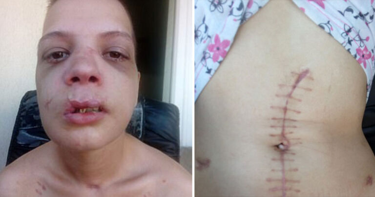 20χρονη Βουλγάρα δείχνει τα τραύματα που υπέστη από εμπόρους λευκής σαρκός της χώρα της