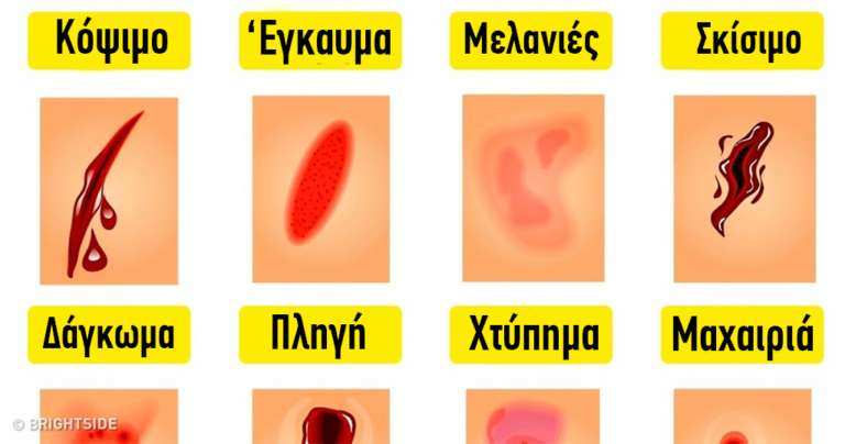 9 λάθη Πρώτων Βοηθειών που κάνουμε συχνά μας τα εξηγούν επαγγελματίες