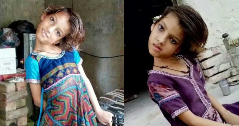 9χρονη στο Πακιστάν ζει με μόνιμα γυρισμένο το κεφάλι της 180 μοίρες