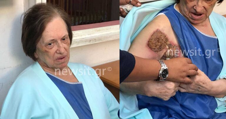 85χρονη στην Κυψέλη άντεξε βασανισμό ληστών με σίδερο σιδερώματος