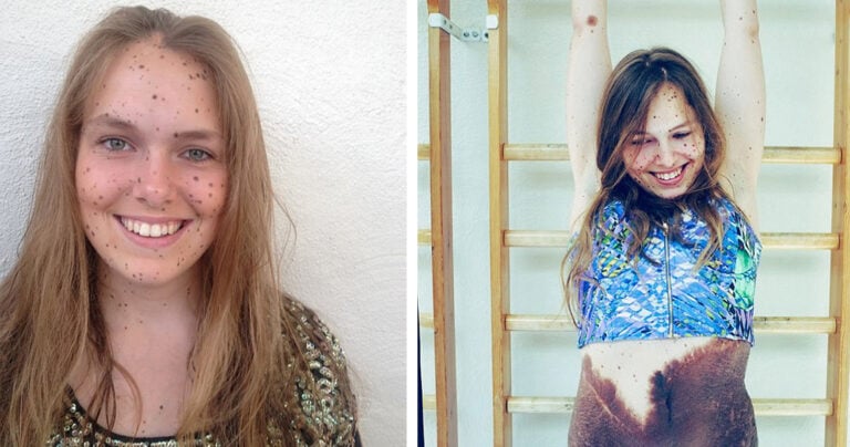 Γυναίκα με σπάνιο σημάδι γέννας στο κορμί της μας λέει γιατί δεν θα το αφαιρέσει ποτέ