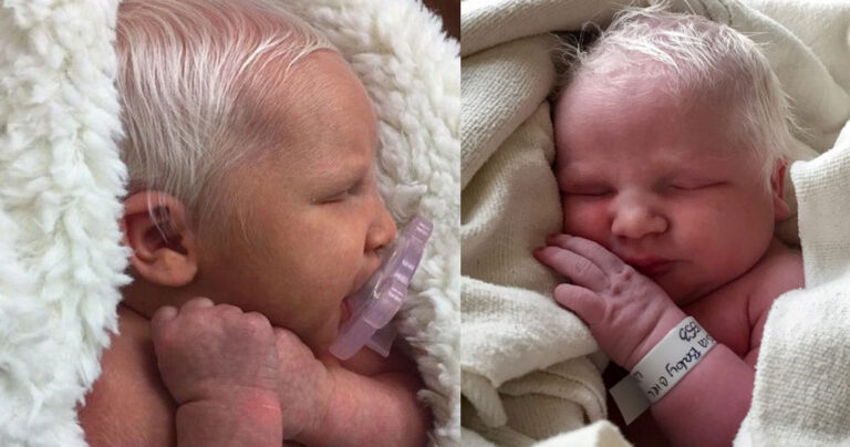 H «αληθινή Χιονάτη» γεννήθηκε με κατάλευκα μαλλιά