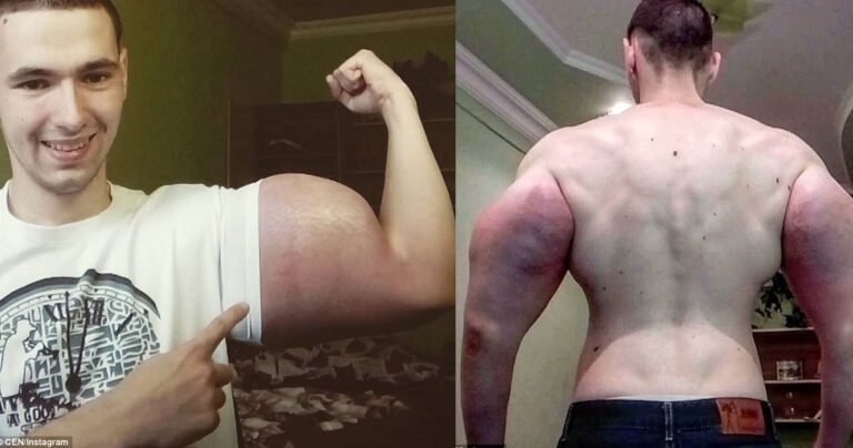 Ρώσος μποντιμπίλντερ έκανε ενέσεις στο σώμα του με χημικά και παραμορφώθηκε