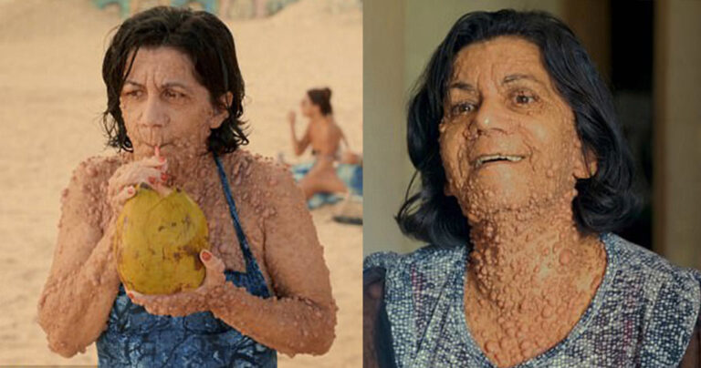 Μητέρα που το δέρμα της είναι γεμάτο όγκους ποζάρει περήφανη με μαγιό