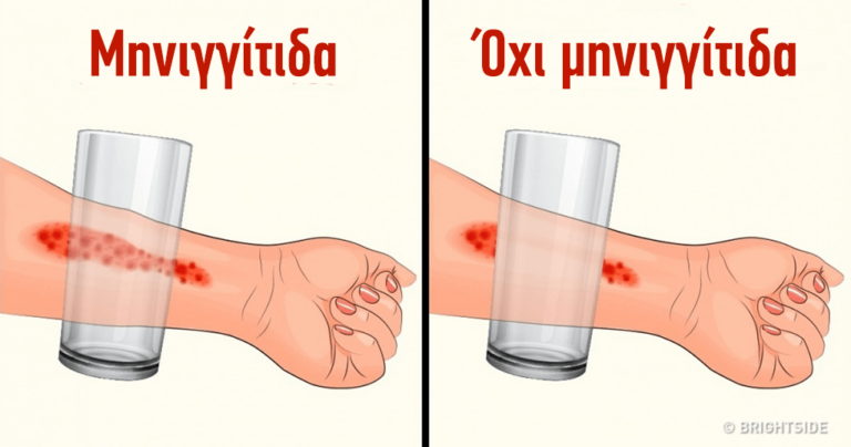 8 συμπτώματα της μηνιγγίτιδας που κάθε γονιός πρέπει να γνωρίζει