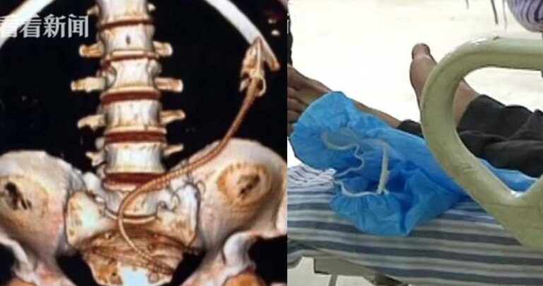 Κινέζος έβαλε ένα χέλι στον πρωκτό του και παραλίγο να χάσει τη ζωή του