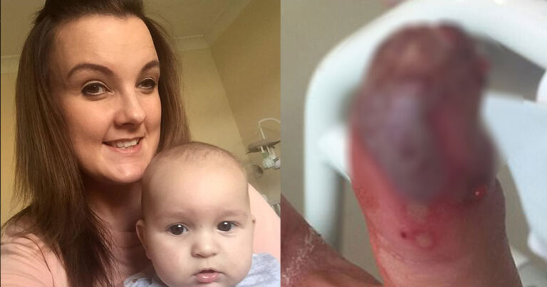 Μητέρα αφαίρεσε μόνη της το ψεύτικο νύχι της και έχασε την άκρη του δακτύλου της