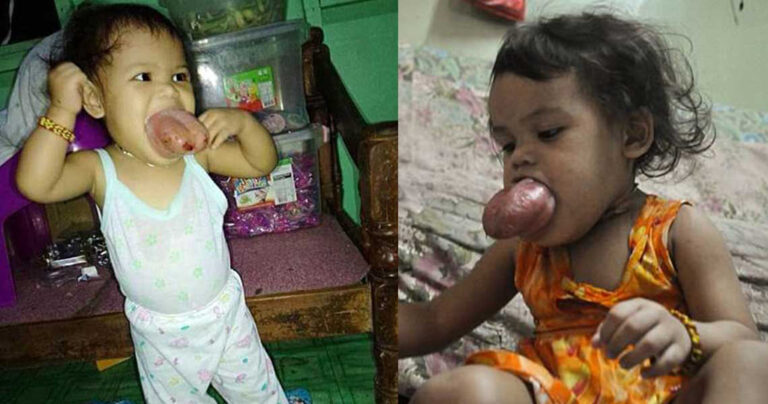 2χρονη με τεράστια γλώσσα κινδυνεύει να πνιγεί αν δεν εγχειριστεί άμεσα