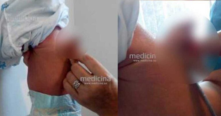 Παιδί στο Αζερμπαϊτζάν γεννήθηκε με ένα επιπλέον πέος στην πλάτη
