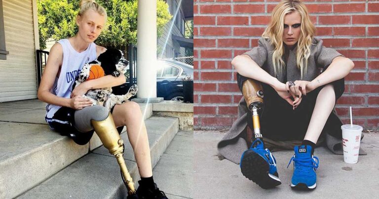 Mοντέλο που έχασε το δεξί του πόδι από χρήση ταμπόν θα χάσει σύντομα και το αριστερό