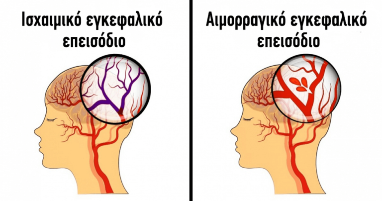 7 συμπτώματα εγκεφαλικών επεισοδίων στις γυναίκες