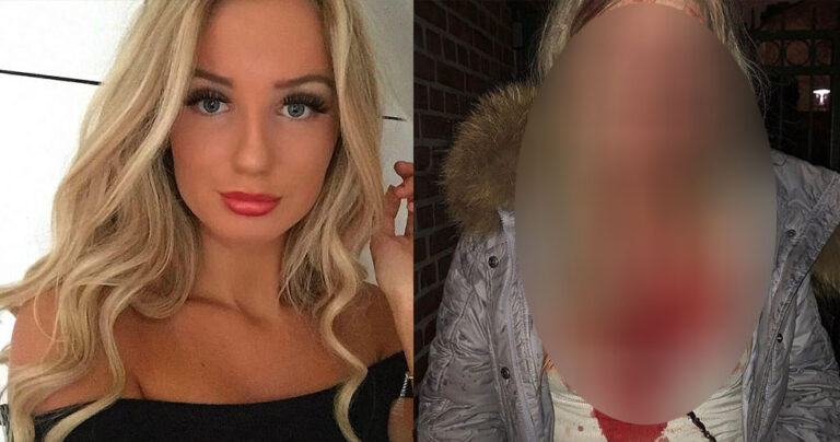 Σουηδία: Τη χούφτωσαν σε κλαμπ και όταν αντέδρασε της έσπασαν το κεφάλι με μπουκάλι