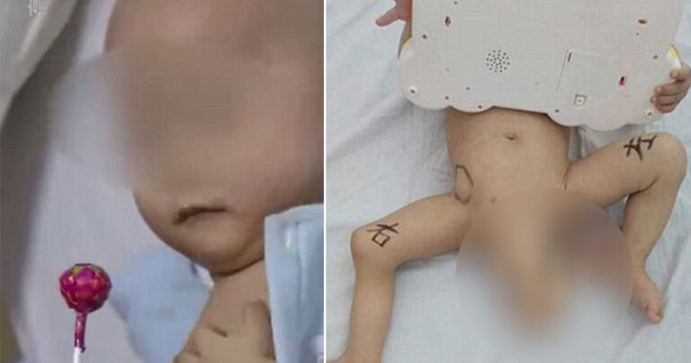 Μωρό στην Κίνα γεννήθηκε με 3 πόδια