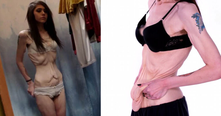 Γυναίκα που έχασε 148 κιλά θέλει απεγνωσμένα να ξεφορτωθεί το περισσευούμενο δέρμα της