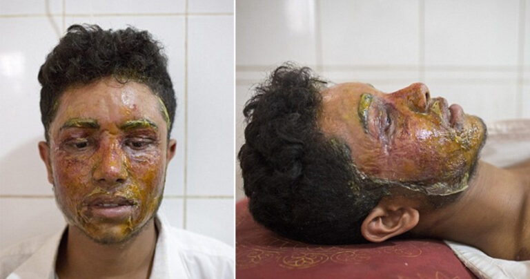 Την απέρριψε ερωτικά και αυτή του έριξε οξύ στο πρόσωπο