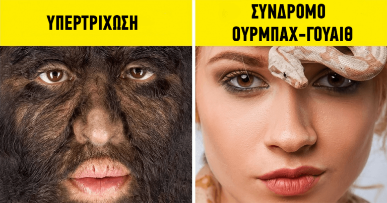 12 παράξενες ασθένειες και σύνδρομα για τα οποία οι γιατροί δεν γνωρίζουν σχεδόν τίποτα