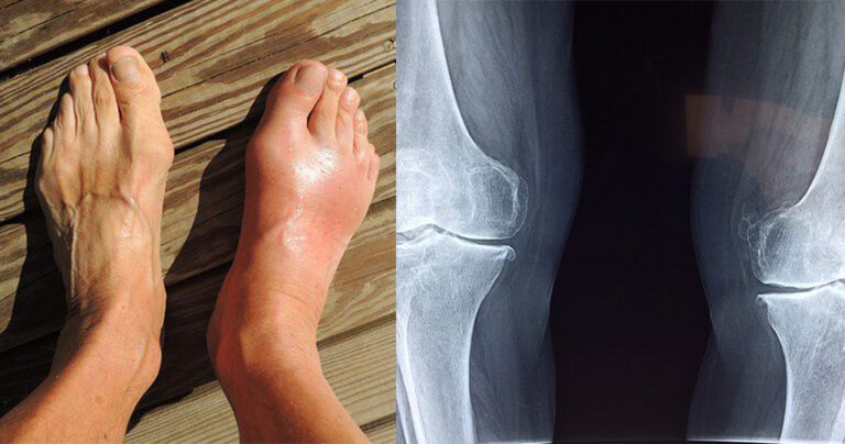 10 πράγματα που δεν ξέρατε για την ουρική αρθρίτιδα και πως να την αντιμετωπίσετε