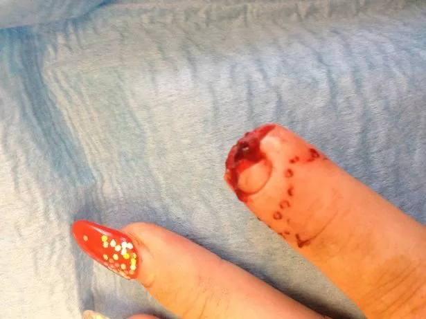 gruesome photos shown to jury in trial of mum accused of biting womans finger off