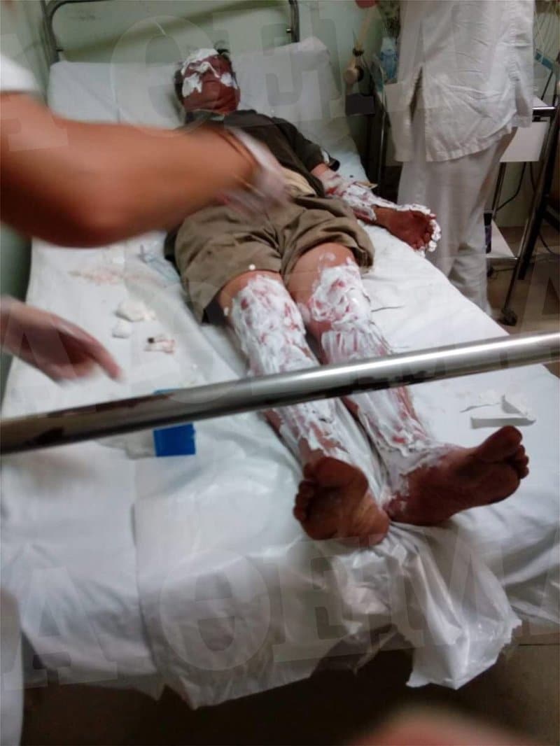 Τραυματίας με εγκαύματα στο νοσοκομείο -Φωτογραφία: protothema
