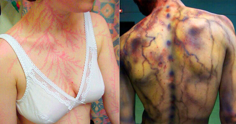 Ανθρωποι που τους χτύπησε κεραυνός δείχνουν τα σημάδια στο σώμα τους