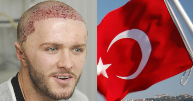 Τουρκία: Ένα δισ. ευρώ αποφέρει ετησίως ο ιατρικός τουρισμός για μεταμόσχευση μαλλιών