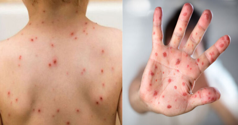 Ιλαρά: 37 θάνατοι το πρώτο τρίμηνο του 2018