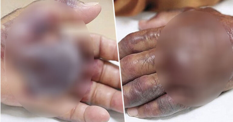 Έφαγε ωμά θαλασσινά, μολύνθηκε και τον ακρωτηρίασαν για να σωθεί