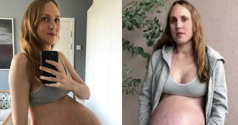 Έγκυος γυναίκα με τρίδυμα δείχνει την πελώρια κοιλιά της