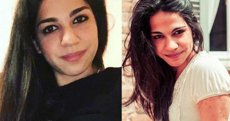 Φωτιά στο Μάτι: Η 26χρονη Ελισάβετ Χαρδαλούπα έχασε την μάχη με την ζωή μετά από 51 μέρες