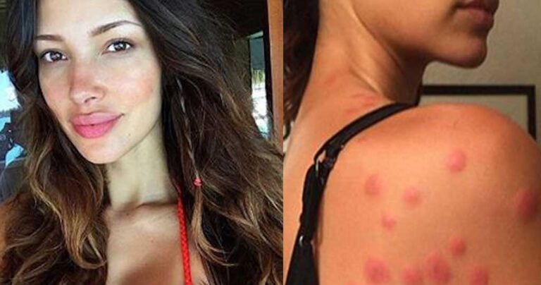 Μοντέλο της Victoria Secret μήνυσε ξενοδοχείο γιατί κοριοί δάγκωσαν 90 φορές το σώμα της