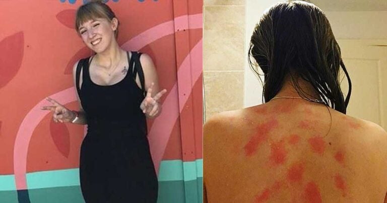 19χρονη έχει αλλεργία στο νερό, τα δάκρυα και τον ιδρώτα της