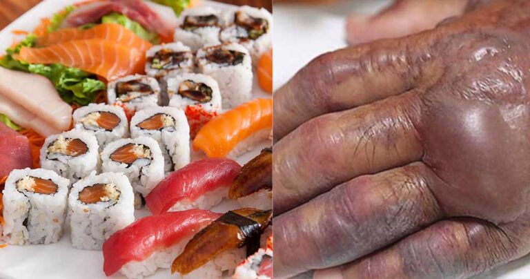 Νότια Κορέα: Τον ακρωτηρίασαν για να σώσουν τη ζωή του μετά τη μόλυνση από σούσι