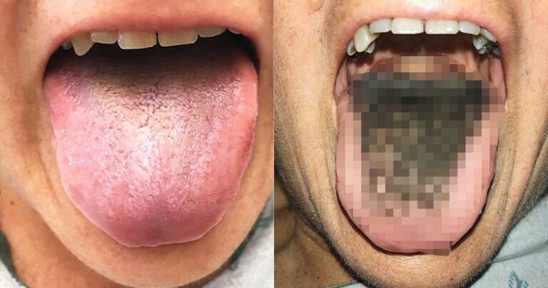 Γυναίκα πήρε αντιβιοτικά και η γλώσσα της έγινε μαύρη και τριχωτή