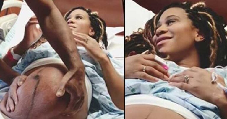 Γιατρός μετακινεί με επιτυχία μωρό μέσα στην μήτρα της μητέρας του για να έχει μια ασφαλή γέννα