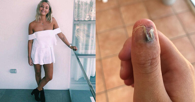 20χρονη εμφάνισε καρκίνο και έκοψε τον αντίχειρά της επειδή έτρωγε τα νύχια της