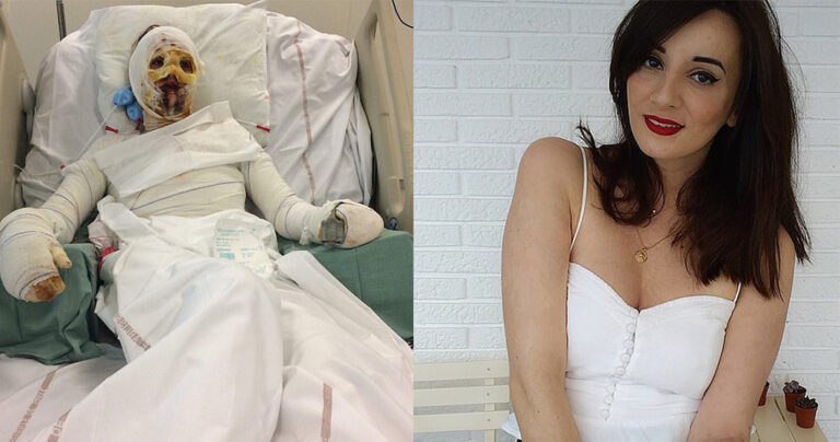 Γυναίκα απέκτησε εγκαύματα στο 90% του σώματός της εξαιτίας αλλεργικής αντίδρασης στην πενικιλλίνη