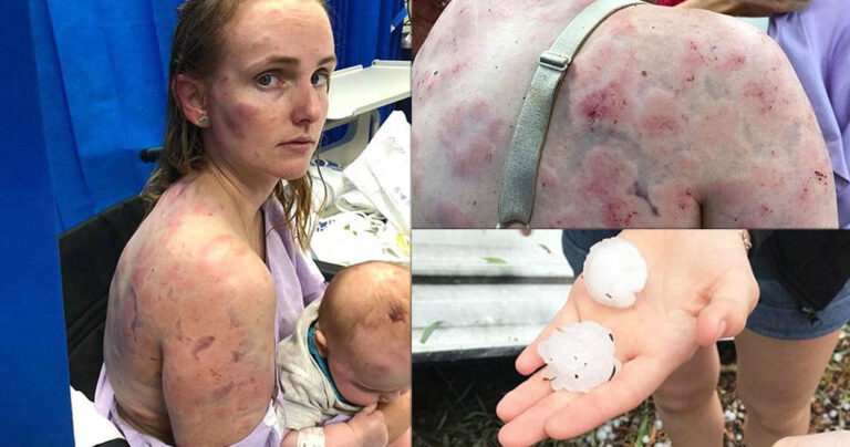 Μητέρα έγινε «ασπίδα» για να προστατεύσει το μωρό της από τη σφοδρή χαλαζόπτωση