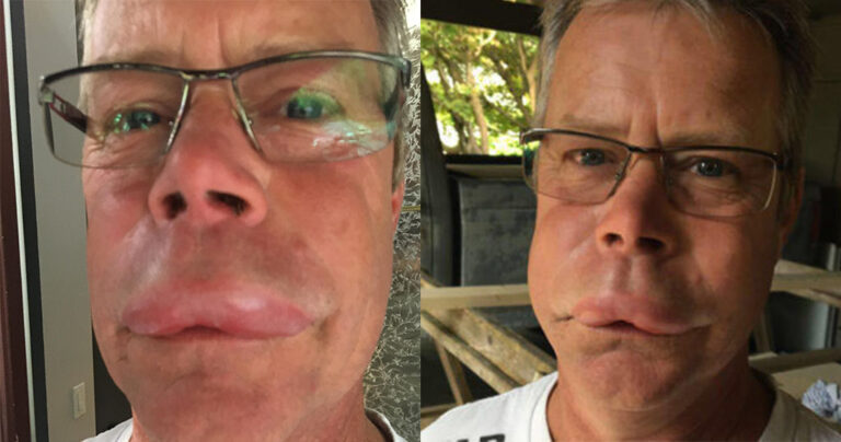 Mέλισσα τσίμπησε 56χρονο που είχε κρυφτεί μέσα στην μπύρα του