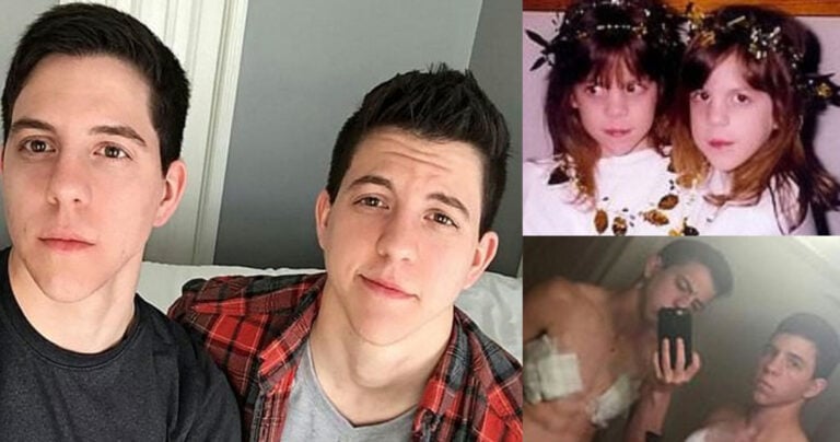 Πανομοιότυπα δίδυμα γεννήθηκαν κορίτσια και έγιναν μαζί τρανσέξουαλ