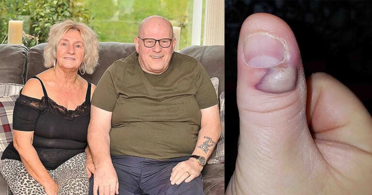 Άντρας παρά λίγο να πεθάνει επειδή εμφάνισε σήψη τρώγοντας τα νύχια του