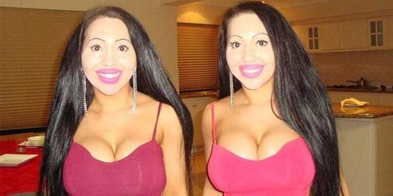 Οι «πιο ίδιες πλαστικές δίδυμες του κόσμου» μετάνιωσαν και γυρίζουν στο φυσικό τους