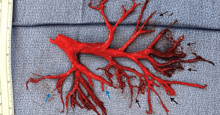 36χρονος ασθενής έβηξε έντονα, έφτυσε μέρος του πνεύμονα του και μετά πέθανε