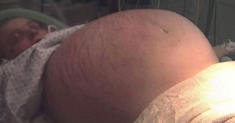 28χρονη νόμιζε ότι ήταν έγκυος, αλλά τελικά ήταν κύστη