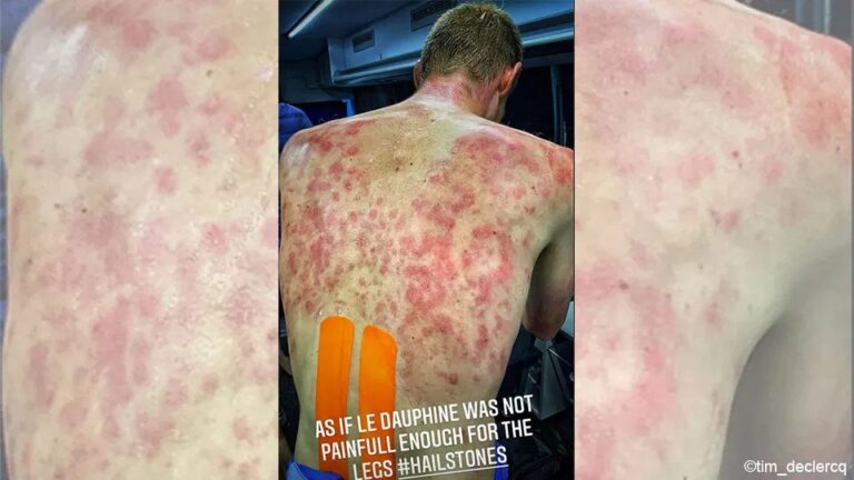 Γαλλία: Χαλάζι «κτύπησε» αθλητές ποδηλασίας – Εικόνες σοκ από τους αθλητές