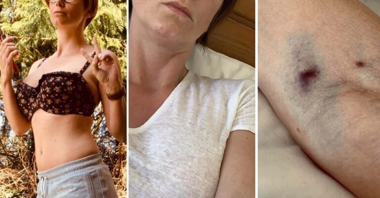 Κύπρος «Νιώθω φριχτά!» έγραφε το 39χρονο μοντέλο πριν πεθάνει από θρόμβωση μετά τον εμβολιασμό