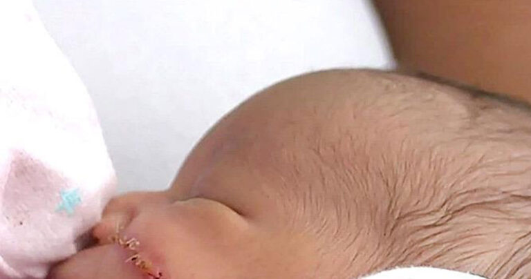 Νεογέννητο χρειάστηκε 13 ράμματα στο πρόσωπο μετά από ατύχημα στην καισαρική